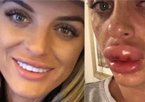 What percent of plastic surgeries go wrong?