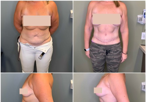 Does stomach come back after tummy tuck?
