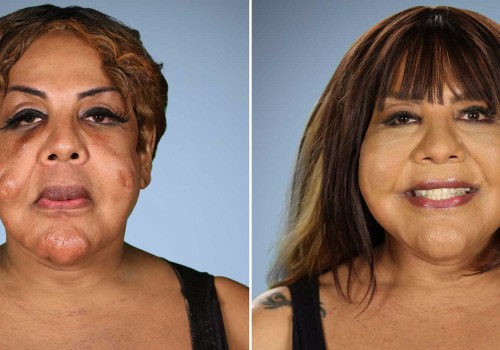 What plastic surgery has the lowest satisfaction rate?
