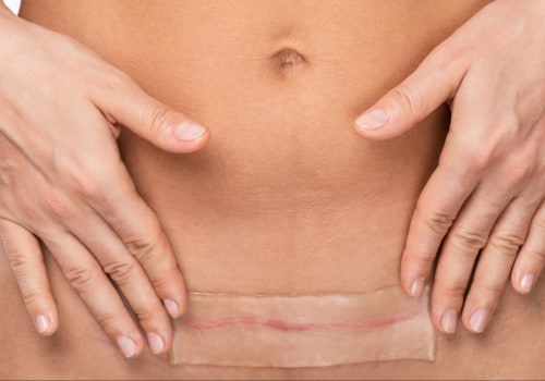 When does a tummy tuck stop hurting?